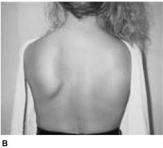 Scapular Dyskinesis